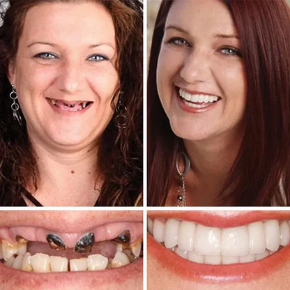 🎉Exclusive Offer Celebrating America's 250th Anniversary💥-KLENIMORE™ Custom-Fit Smile Support Kit