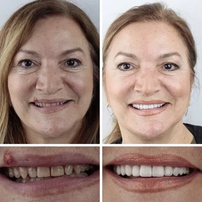 🎉Exclusive Offer Celebrating America's 250th Anniversary💥-KLENIMORE™ Custom-Fit Smile Support Kit