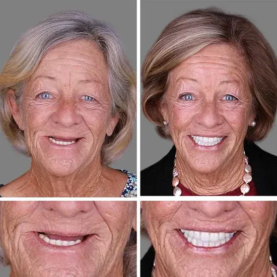 🎉Exclusive Offer Celebrating America's 250th Anniversary💥-KLENIMORE™ Custom-Fit Smile Support Kit