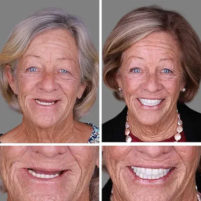 🎉Exclusive Offer Celebrating America's 250th Anniversary💥-KLENIMORE™ Custom-Fit Smile Support Kit